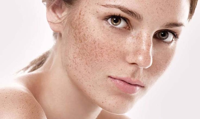 Hạn chế tiếp xúc với ánh sáng mặt trời để ngăn ngừa nám da
