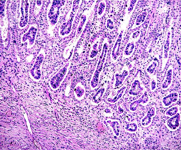 Implantation of villi within the white spaces of endometrium. They interdigitate with the endometrial caruncular epithelium but they do not invade