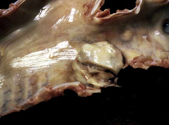 Bronchial rhabdomyoblastoma causing bronchial obstruction. Tumours of the respiratory tract are rare in horses. Original photograph by Dr Roger Breeze, during his appointment at Washington State University.