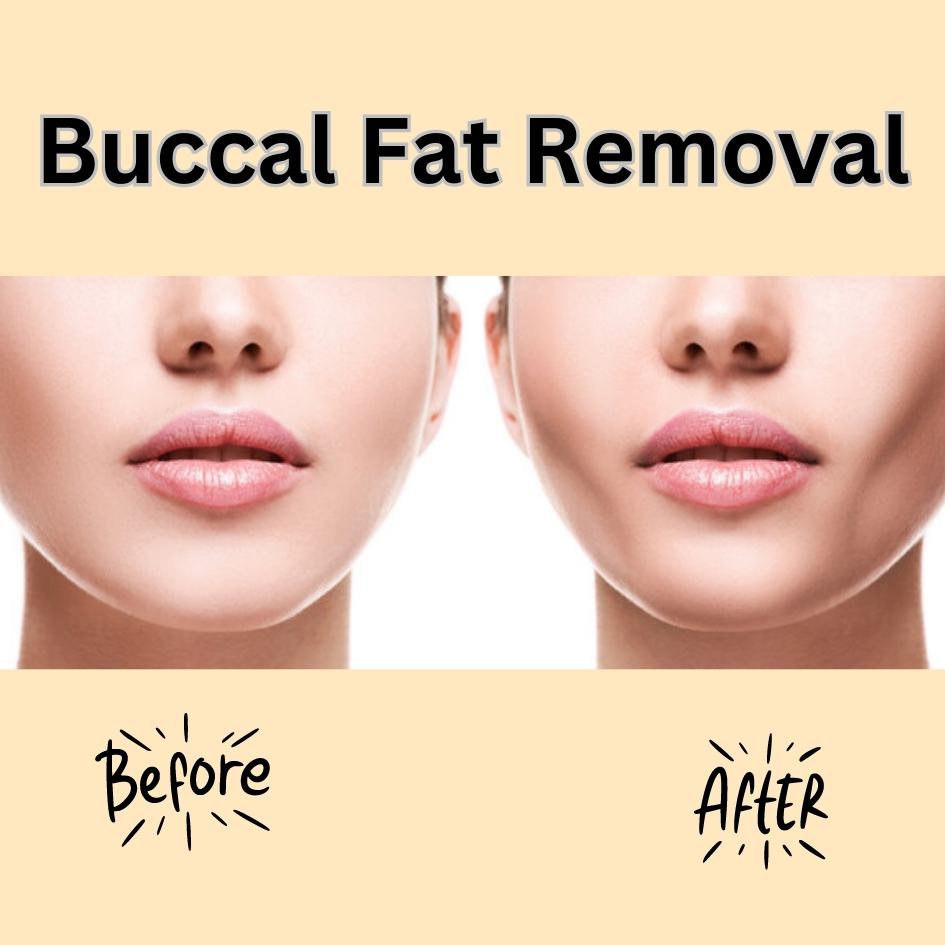 buccal fat removal turkey before/after