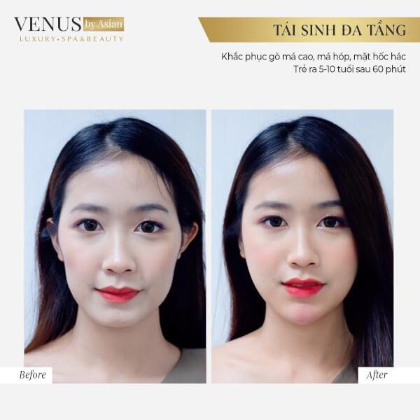 Khách hàng thực hiện Tái sinh đa tầng tại Phòng khám thẩm mỹ Venus by Asian