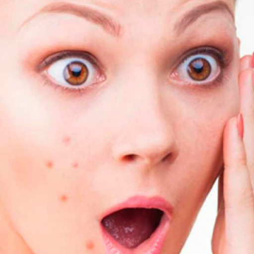 10 REMEDIOS QUE CURAN EL ACNE Screen 1