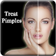 Download Pimple Remove in 7 Days For PC Windows and Mac 1.0