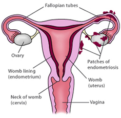 Endometriosis sites