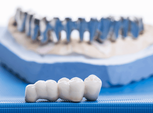 Krown Dental - Dentist Merrylands - Thumbnail