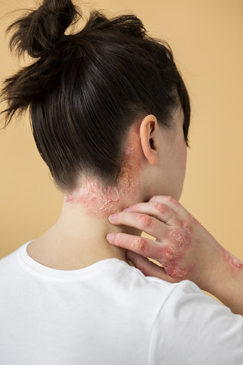 Several factors, including excess oil production, environmental changes, stress, and individual s… post image