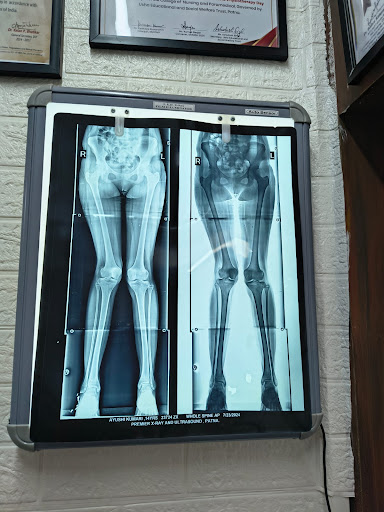 Genu Valgum Physiotherapy