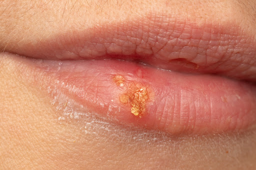 Cold sores are small, fluid-filled blisters that typically develop around the lips and mouth. Tri… post image