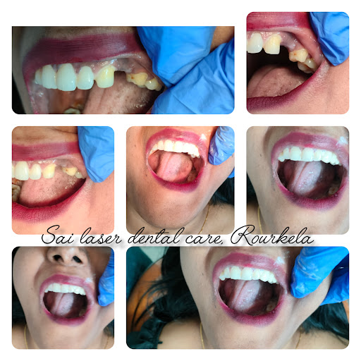 Your MISSING tooth has a fix, and it’s painless at Sai Laser dental care. post image