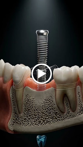🦷 Dental Implants in Siliguri | Face & Teeth Dental Clinic post image