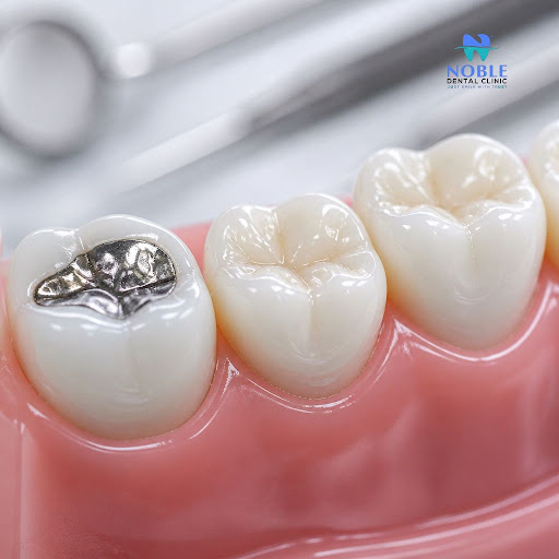 Tooth-coloured fillings are a modern, safe and natural-looking way to restore damaged teeth witho… post image