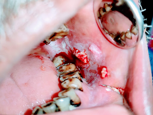 Squamous cell carcinoma patient. post image