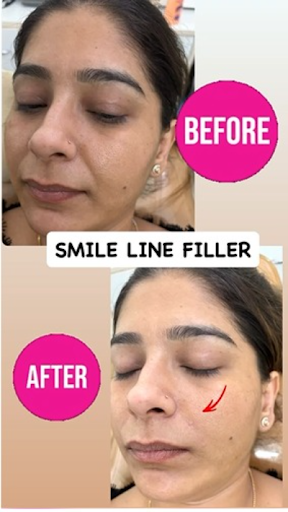 Botox injection in tri nagar | Dermal fillers in tri nagar | Skin Tightening treatment in keshav…