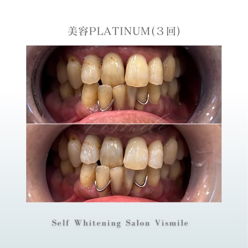 医療提携ホワイトニングサロン Vismile