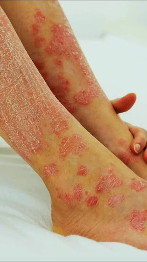 Struggling with Psoriasis, red patches, itchy skin, or scali