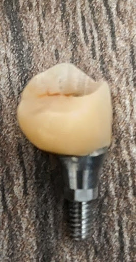 🦷 Get a Strong, Natural-Looking Smile with Dental Implants at Revive Face Dental Centre! post image