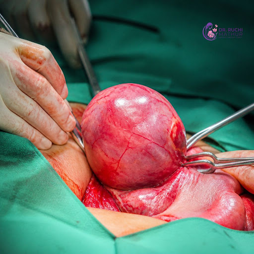 Struggling with uterine fibroids and looking for a safe way to preserve your uterus? A myomectomy… post image