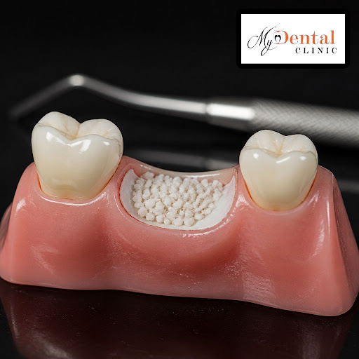 When a tooth is removed, the jawbone can slowly shrink, making future treatment like dental impla…