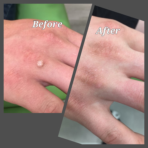 North Yorkshire Verruca and Wart Clinic - Thumbnail