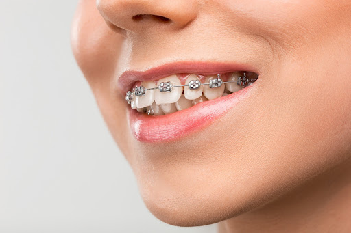 Metal Braces Treatment moves teeth into better positions using small stainless-steel brackets joi… post image