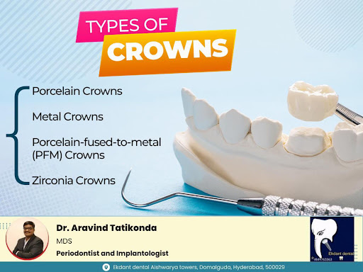 Dental crowns come in various types such as porcelain ceramic metal and porcelain-fused-to-metal… post image