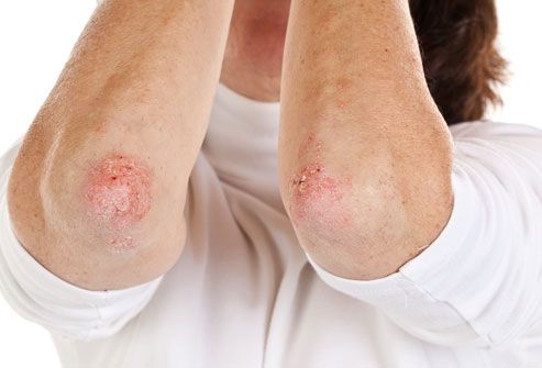 Struggling with psoriasis symptoms like red, itchy, or scaly