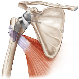 Photo n°21 de Dr Maxime Antoni à Strasbourg (Chirurgien orthopédiste)
