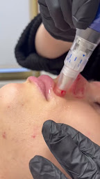 Photo n°13 de Centre Dermo Laser Montpellier - Epilation Laser & Définitive - Détatouage à Montpellier (Service de détatouage)