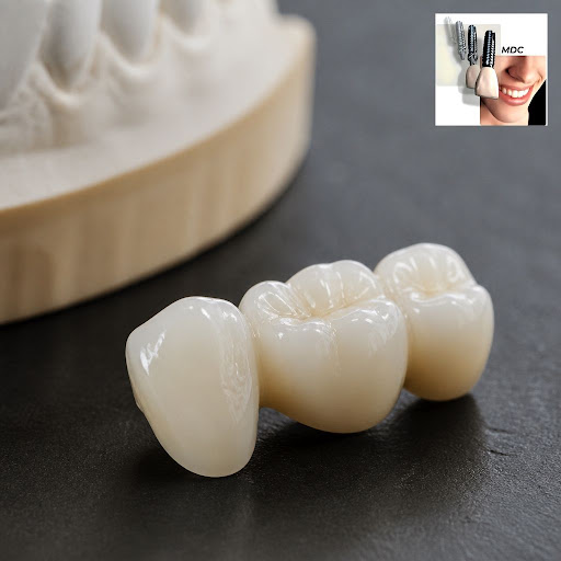 Want a smile that looks natural after dental treatment? Ceramic crowns are a great choice for lon… post image