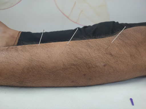 Dry Needling for foot drop post image