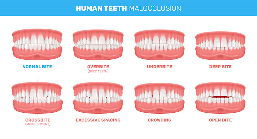 Understanding overbite teeth and crossbite teeth in children is an important part of monitoring h… post image