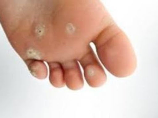 CORNS AND HOMEOPATHIC TREATMENT post image