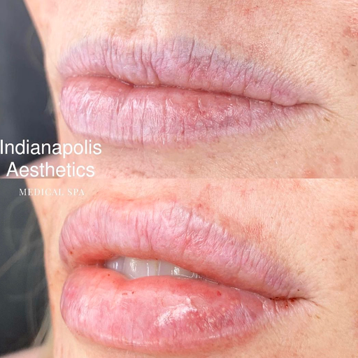 Indianapolis Aesthetics Medspa