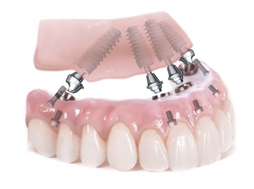 Dott. Antonio Luongo, Dentista Implantologia Salerno - Thumbnail