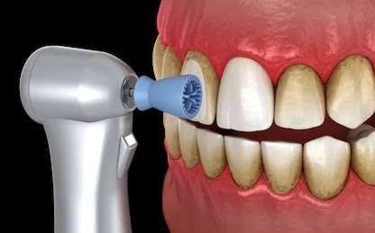 Complementary polishing and fluoride treatment with every dental scaling(cleaning). post image