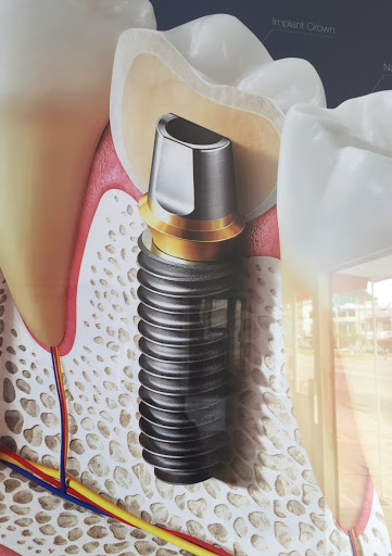 Odontología Integral Tepic; Implantes Dentales, Rehabilitación Bucal, Endodoncia. - Thumbnail