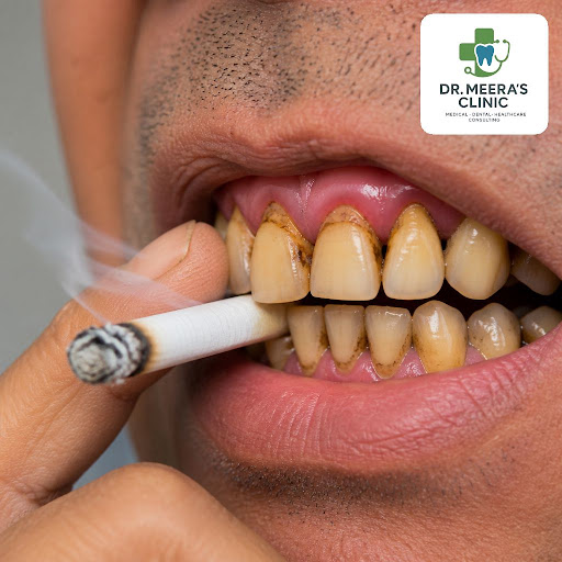 Smoking doesn’t just affect your lungs – it slowly destroys your teeth and gums, often causing pe… post image
