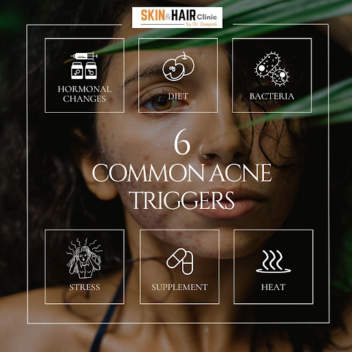Acne can be frustrating, and understanding common triggers is essential for effective treatment.…