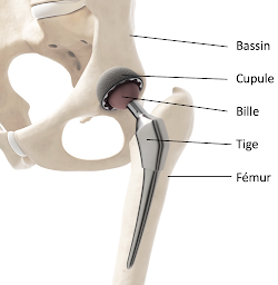 Photo n°12 de Docteur Simon Tournemine - Chirurgien orthopédiste - Spécialiste sport et arthrose - Hanche, Genou, Cheville, Pied à Saint-Germain-en-Laye (Chirurgien orthopédiste)
