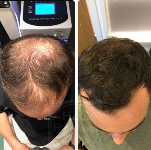 Cardiff Hair Loss Clinic - Thumbnail