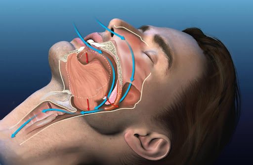 Obstructive Sleep Apnea (OSA) is a common sleep disorder where breathing repeatedly stops and sta… post image