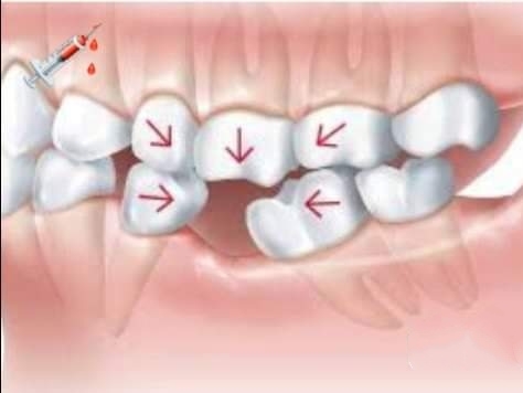 A single lost or damaged tooth can influence your daily life. Even though it may be at the back o…