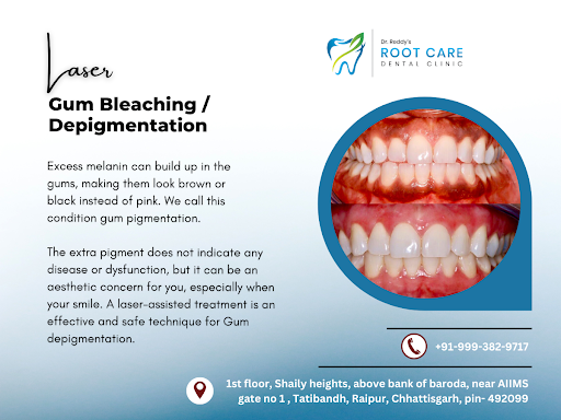 Dark gums make you conscious while speaking and affect you psychologically. You can now get rid o…