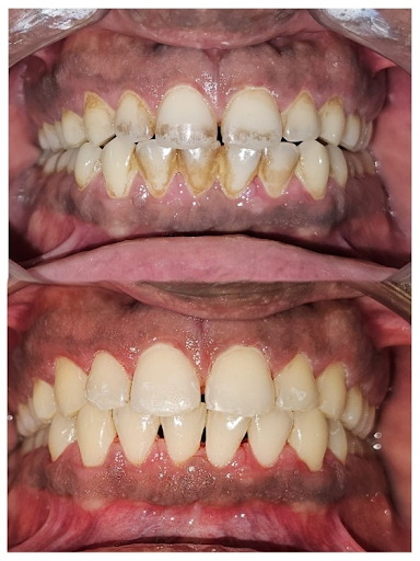 Post Body: Don't let yellow teeth or stains hide your smile! At Sniora Dental & Aesthetics, we of… post image