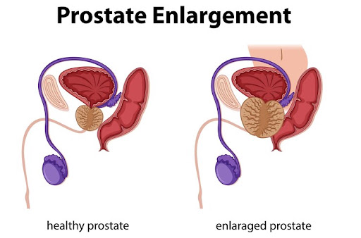 Transurethral Incision of the Prostate (TUIP) is a minimally invasive urological procedure used t…