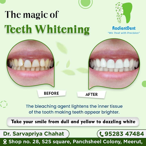Experience the magic of teeth whitening at RadientDent, the premier teeth whitening clinic in Mee… post image