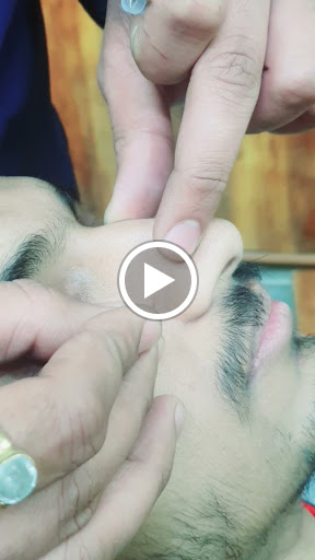 Viddhakarma for senseless nasal post image