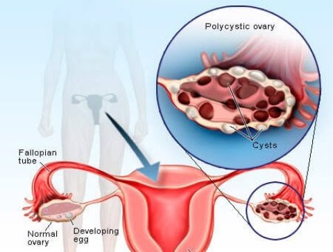 PCOD (poly cystic ovarion disease) post image