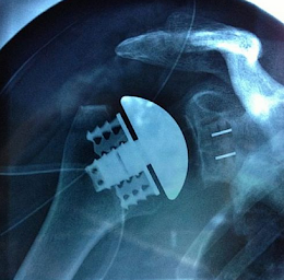 Photo n°16 de Docteur Marc-Olivier Falcone à Champigny-sur-Marne (Chirurgien orthopédiste)