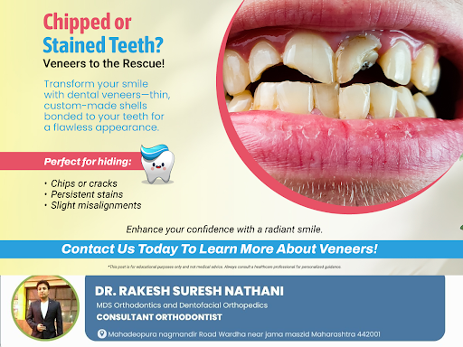 Struggling with chipped, cracked, or stained teeth? Dental veneers offer the perfect fix! These c… post image